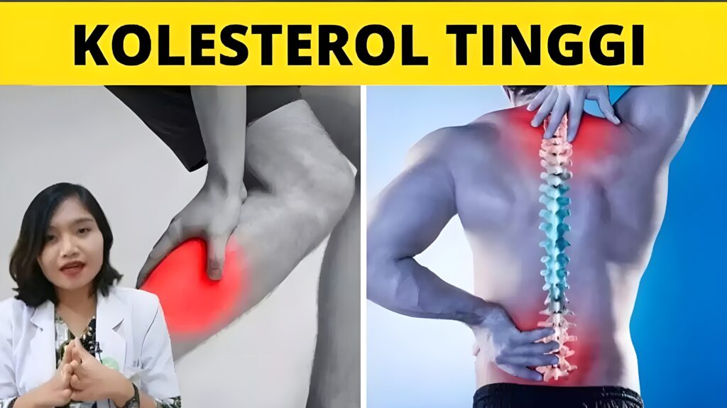 Inilah Gejala Kolesterol Tinggi yang Perlu Diwaspadai