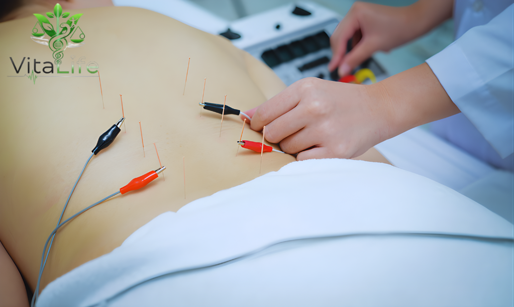 Apa Itu Akupuntur dan Apa Manfaatnya?
