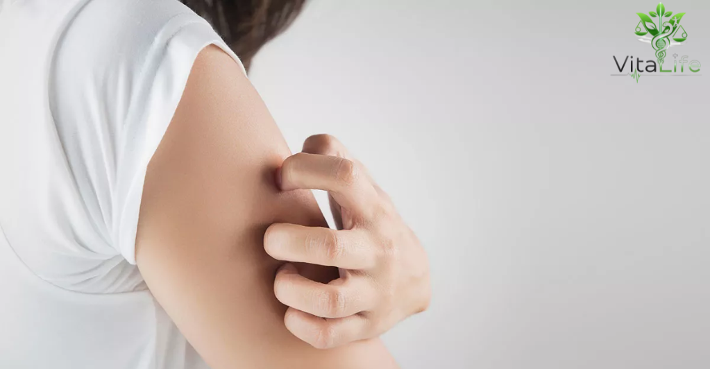 Reaksi Anafilaktik: 7 Fakta Serius Akibat Gigitan Serangga yang Wajib Diwaspadai